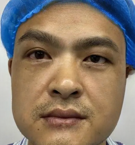 去眼袋手术