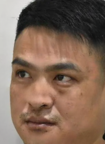 去眼袋手术