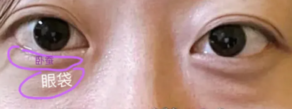 去眼袋手术