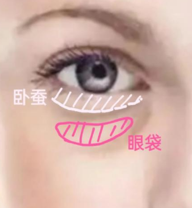 去眼袋手术