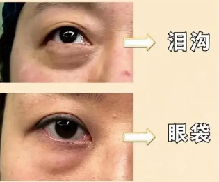 去眼袋手术