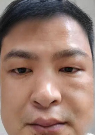 去眼袋手术