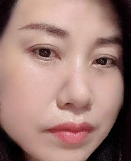 去眼袋手术