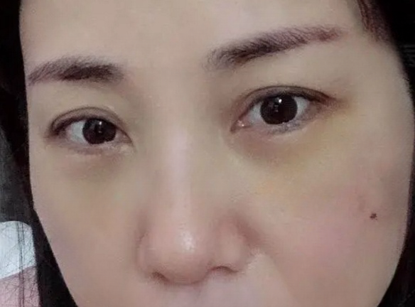 去眼袋手术