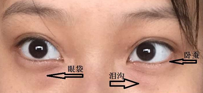 去眼袋手术