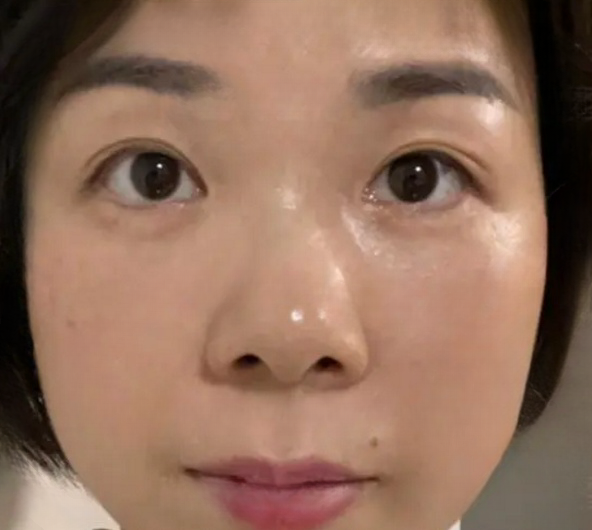 去眼袋手术