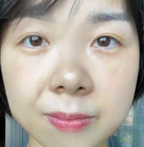 去眼袋手术