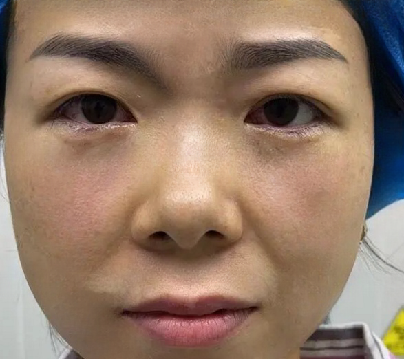 去眼袋手术