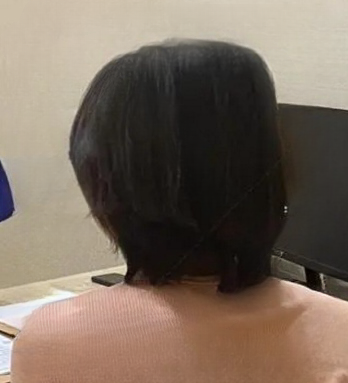 去眼袋手术