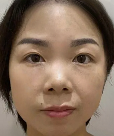 去眼袋手术