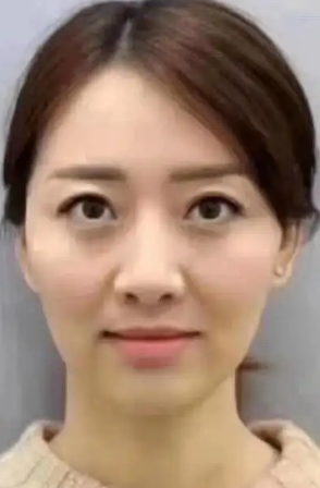 去眼袋手术