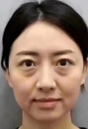 去眼袋手术