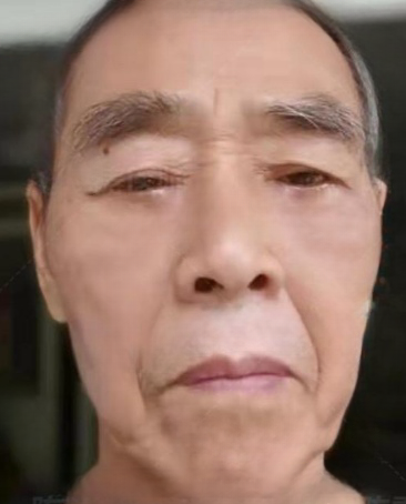 去眼袋手术