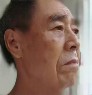 去眼袋手术