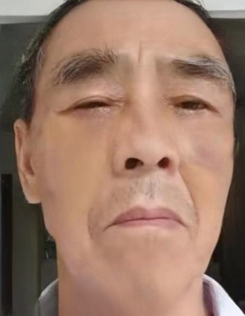 去眼袋手术