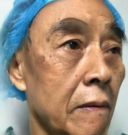 去眼袋手术