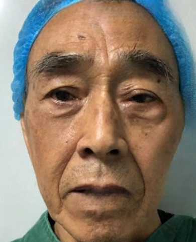 去眼袋手术