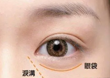 去眼袋手术