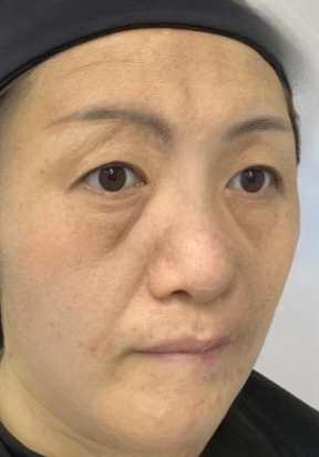 去眼袋手术