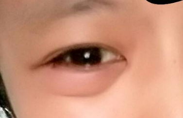 去眼袋手术