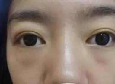 眼袋手术