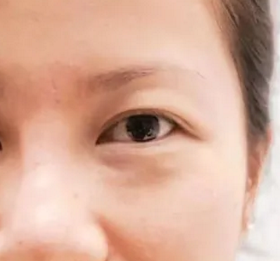 眼袋手术