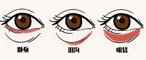 去眼袋手术