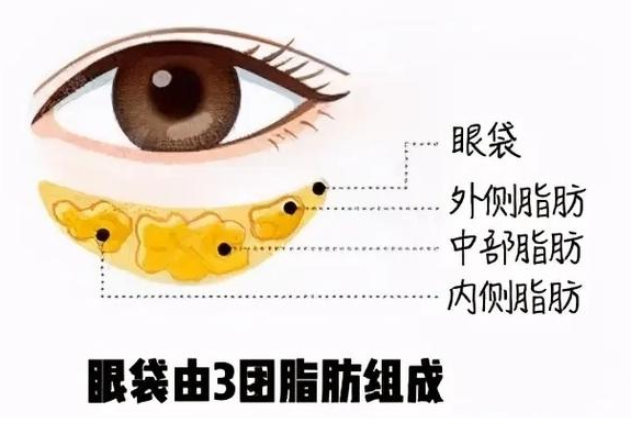 去眼袋手术