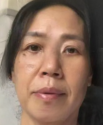 去眼袋手术