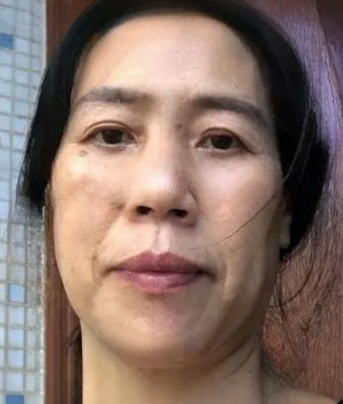 去眼袋手术