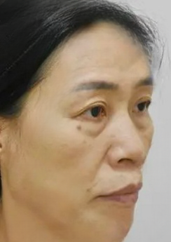 去眼袋手术