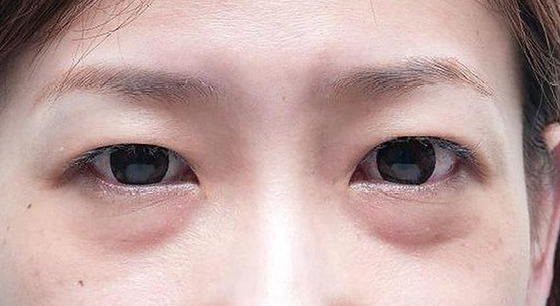 去眼袋手术