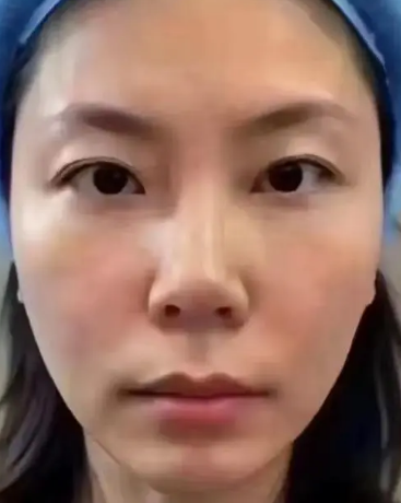 眼袋