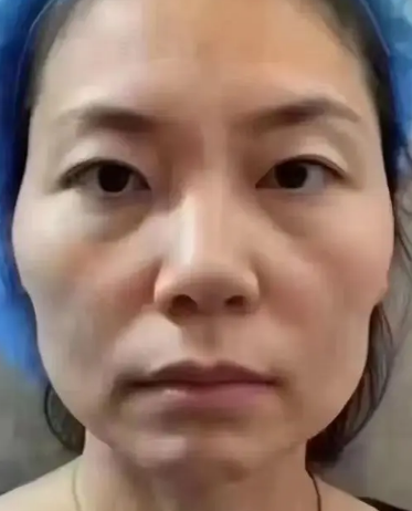 眼袋