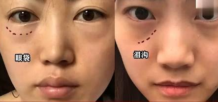 眼袋