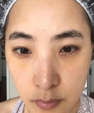 去眼袋手术