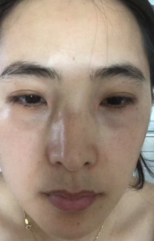 去眼袋手术