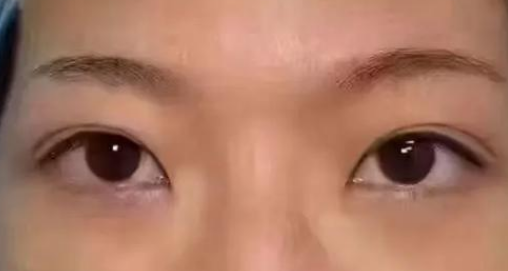 去眼袋手术