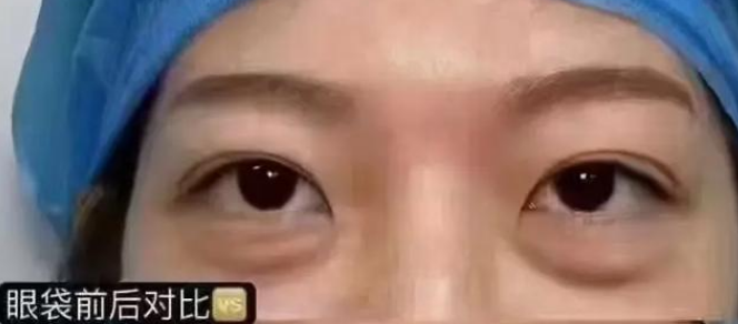 去眼袋手术