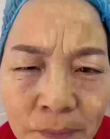 去眼袋手术