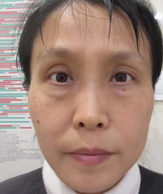 去眼袋手术