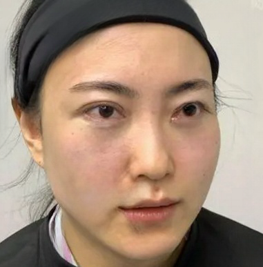 去眼袋手术