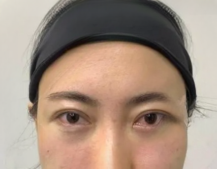 去眼袋手术