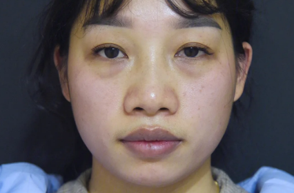 去眼袋手术