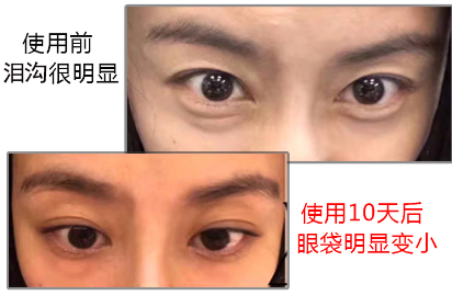 去眼袋手术