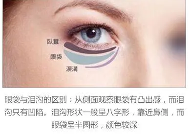 去眼袋手术