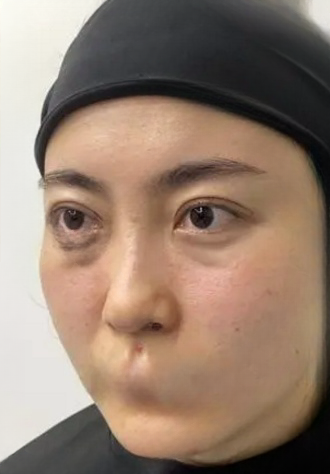 去眼袋手术