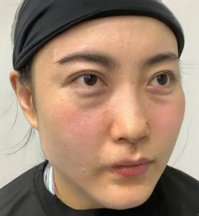 去眼袋手术
