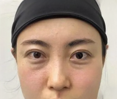 去眼袋手术
