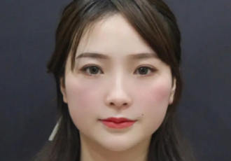 去眼袋手术
